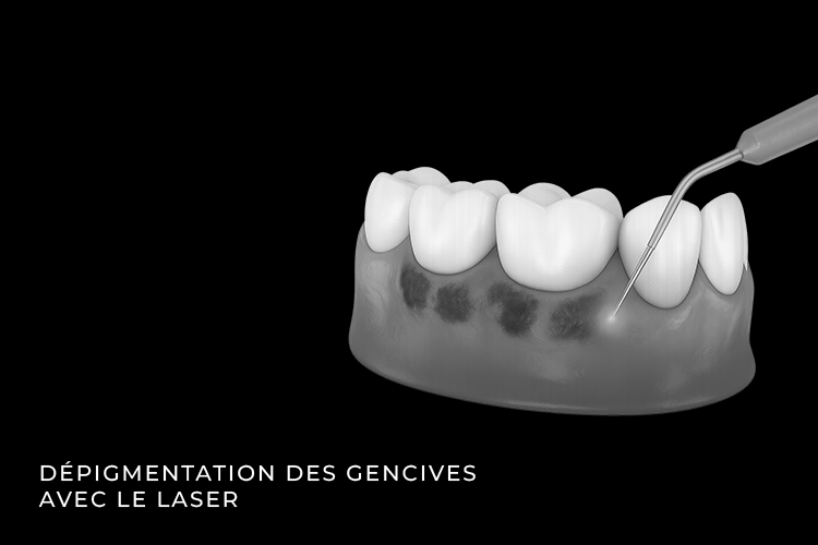 Dépigmentation des gencives avec le laser