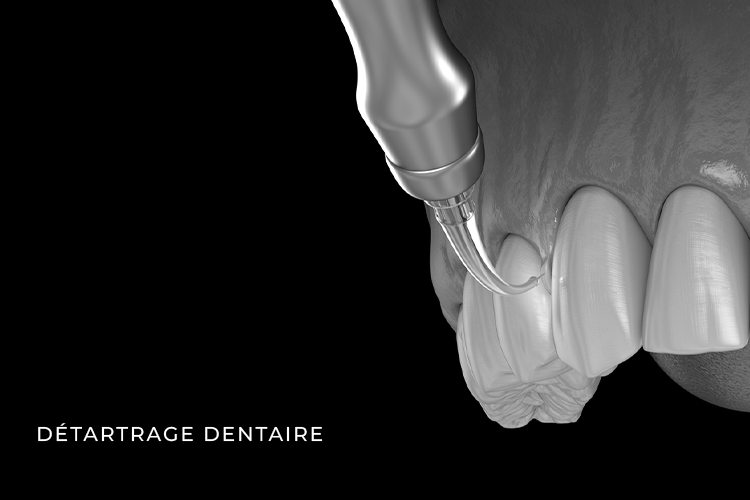 détartrage dentaire