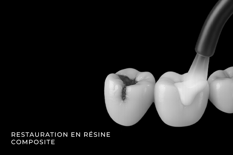 resine composite