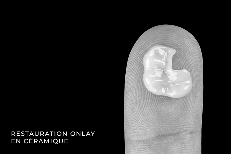 restauration onlay en céramique